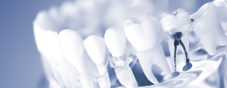 Wurzelbehandlung in Elbingerode/Ostharz mit modernen Verfahren